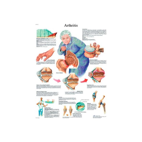 3B Anatomical Chart - Arthritis, Laminated